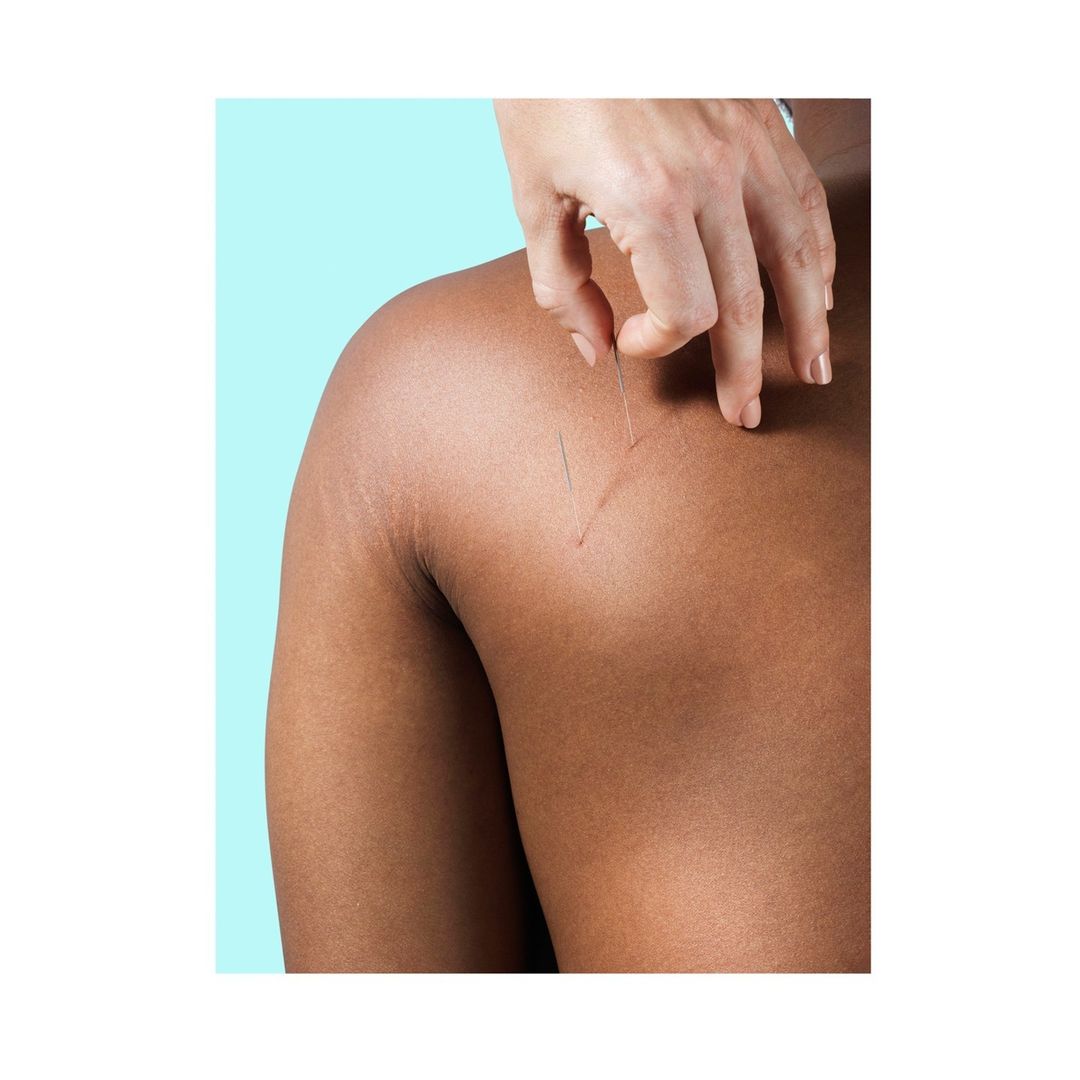 Alice Douglas | Acupuncture |  Jun. 23